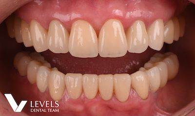 Full-mouth Reconstruction_after