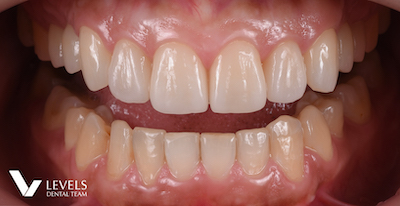 Laminate Veneer/Crown Monolithic Restoration-e.max・Zirconia-_after01