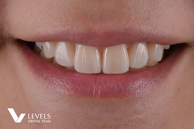 Laminate Veneer/Crown Monolithic Restoration-e.max・Zirconia-_after02