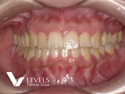 Laminate Veneer/Crown Monolithic Restoration-e.max・Zirconia-_before