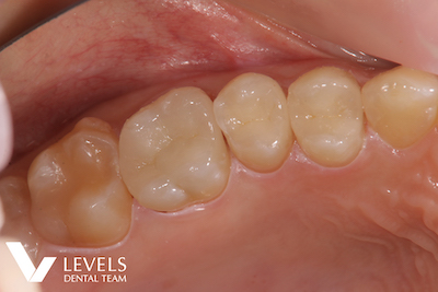 All Ceramic Inlay -e.max-_after