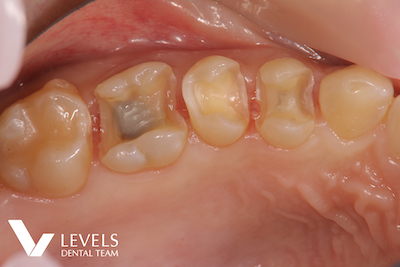 All Ceramic Inlay -e.max-_before