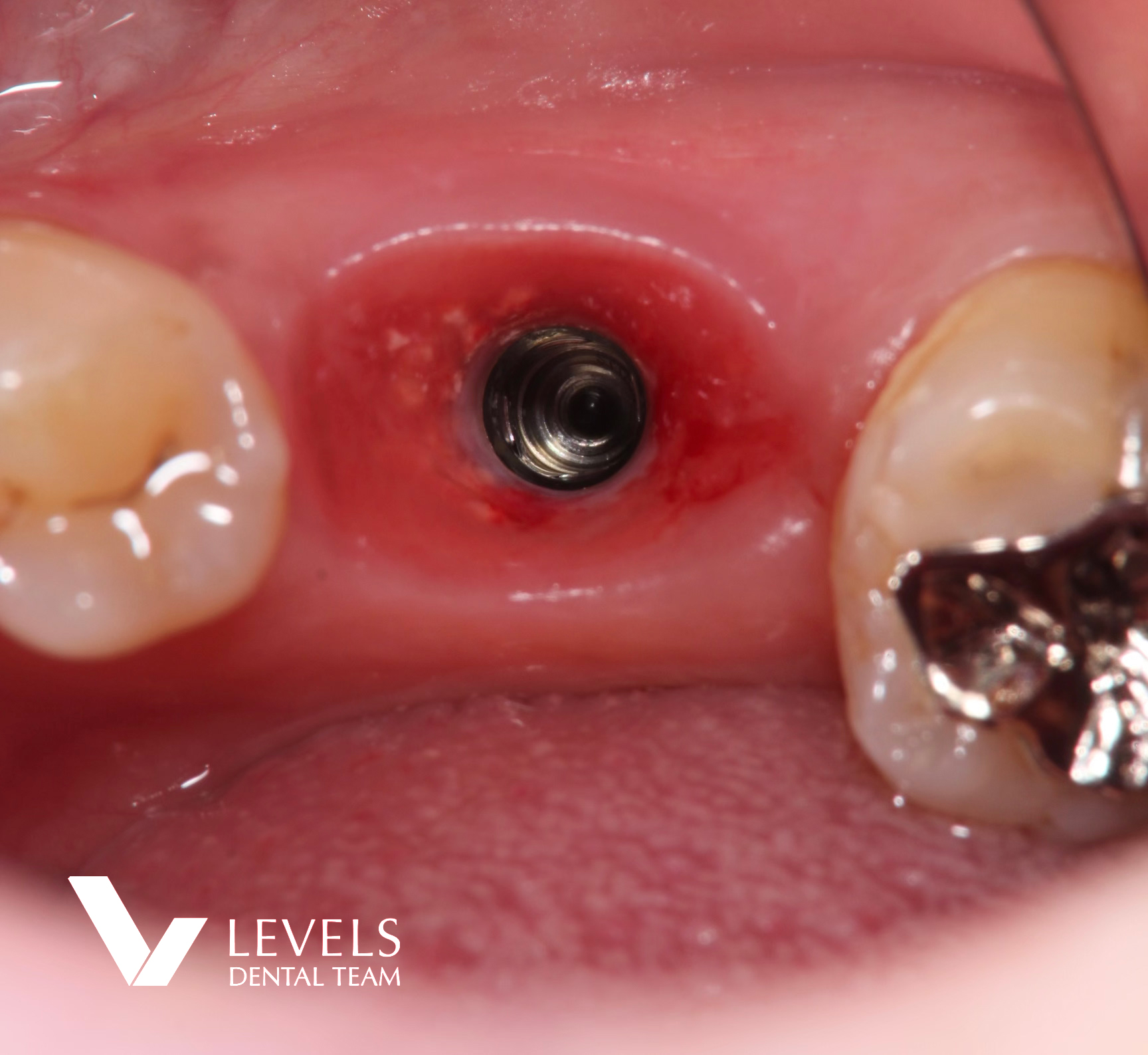 Implant Monolithic Restoration-Zirconia-_before