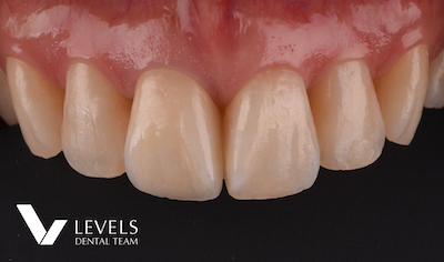 All Ceramic Crown –PFZ-_after01