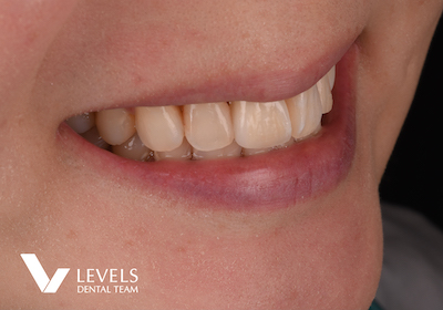 All Ceramic Crown –PFZ-_after02