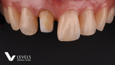 All Ceramic Crown –PFZ-_before