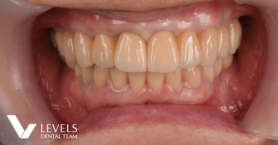 Full-mouth Reconstruction_after01