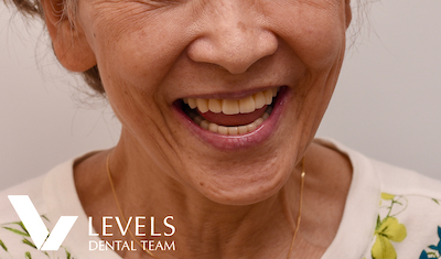 Full-mouth Reconstruction_after02