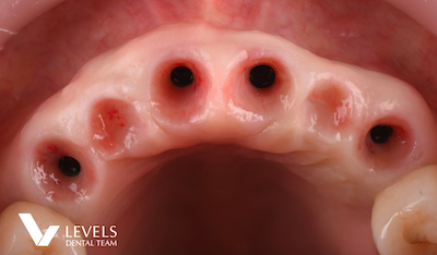 Full-mouth Reconstruction_before02